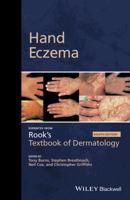 Hand Eczema